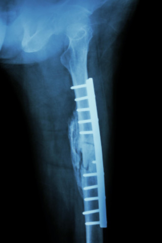 hip replacement surgery